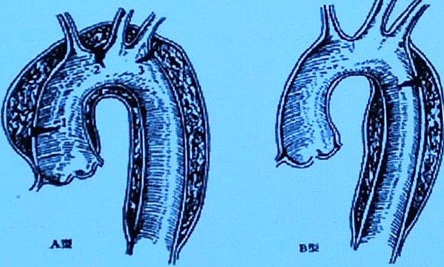 科普｜死亡率极高的主动脉夹层你了解多少