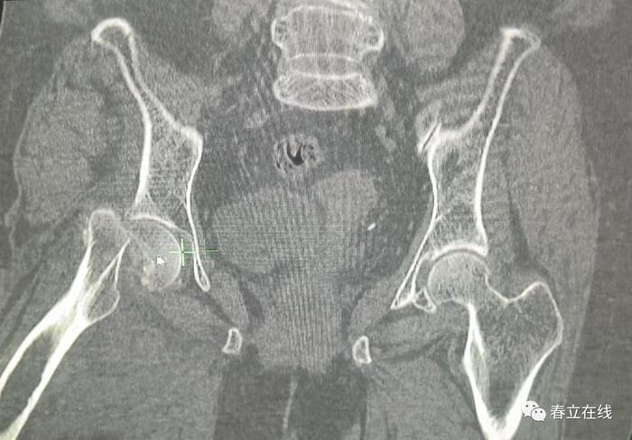 【优选病例】股骨假体周围骨折手术分享