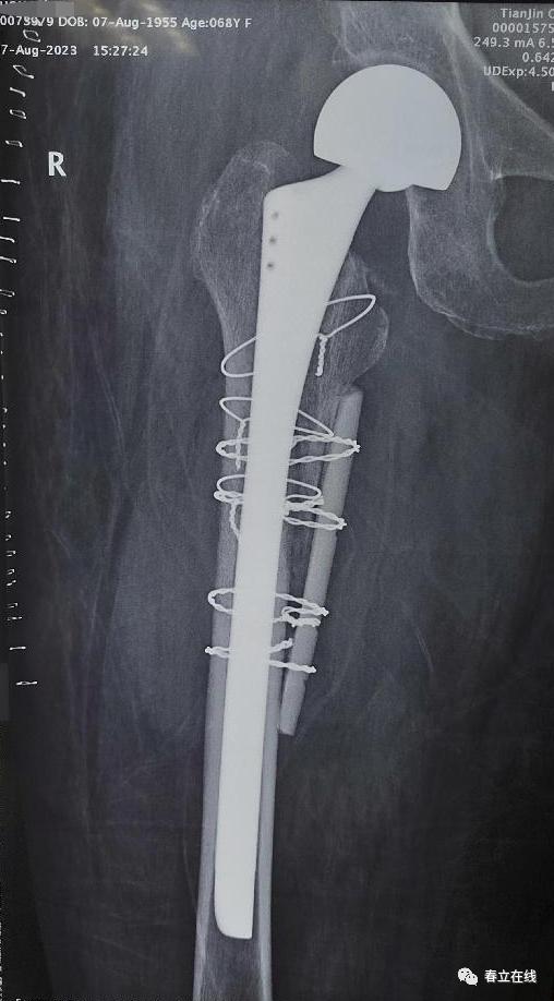 【优选病例】股骨假体周围骨折手术分享