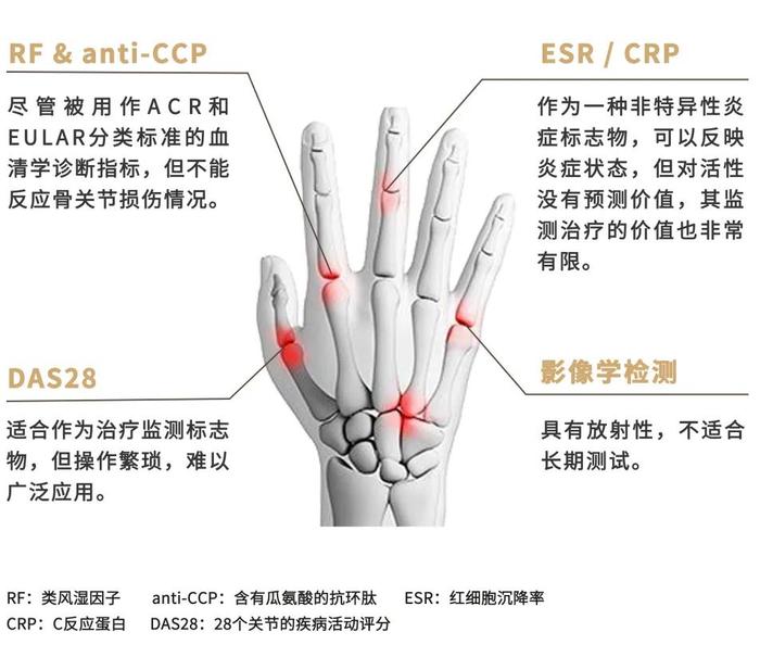 新品上市｜类风湿性关节炎新指标——基质金属蛋白酶3