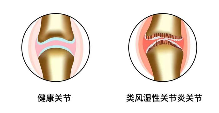 新品上市｜类风湿性关节炎新指标——基质金属蛋白酶3