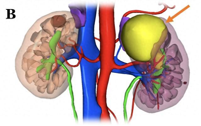 瑞金病例丨肾肿瘤患者的福音：切瘤保肾或许可行