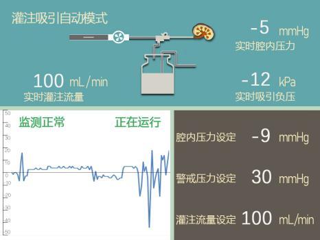 CUA2023丨医为特智能控压：引领输尿管软镜取石技术的新时代