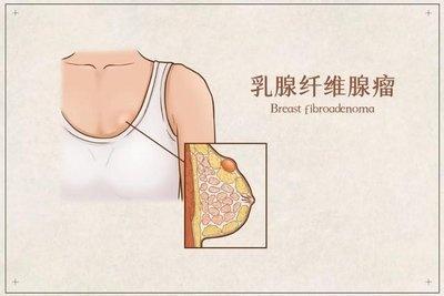 气到胸痛！乳腺结节真是气出来的？