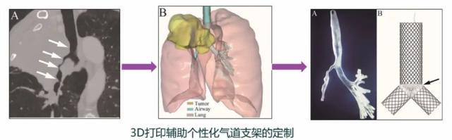 瑞金医术丨这个技术让呼吸困难患者在36小时内赢得生机