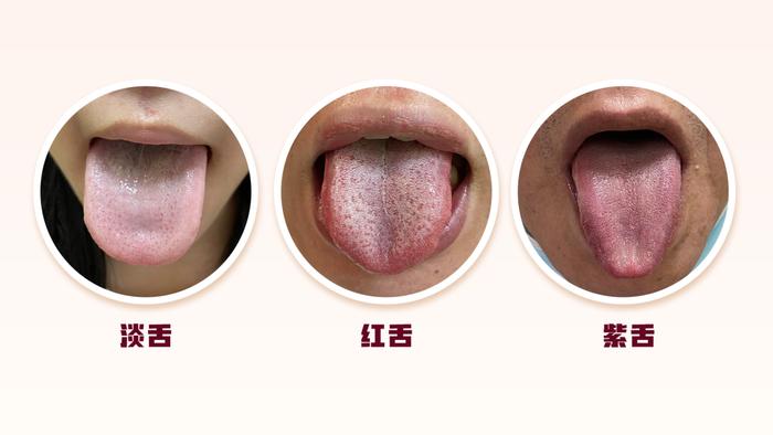 身体好不好，舌头先知道？舌头这些变化，可能与肌瘤、肿瘤相关！自查→