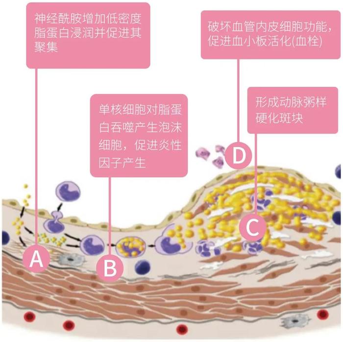 热胀冷缩！冬季血管更易堵塞，这6个脑血栓前兆一定要当心！