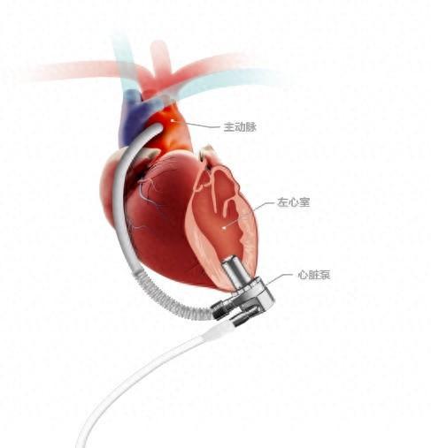 重获“心”生！山大二院成功为终末期心衰患者植入“人工心脏”