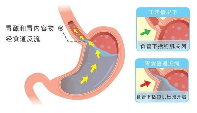 胃酸从耳朵里冒出来？！男子耳鸣一个月后被确诊……医生：与情绪饮食有关！职场人易中招！