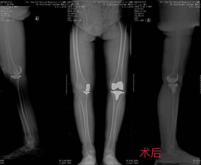 重医二院·医界绝技｜强“关”劲“节” ④ 80岁患者先后接受左右膝手术，单髁置换为她保留“膝”望