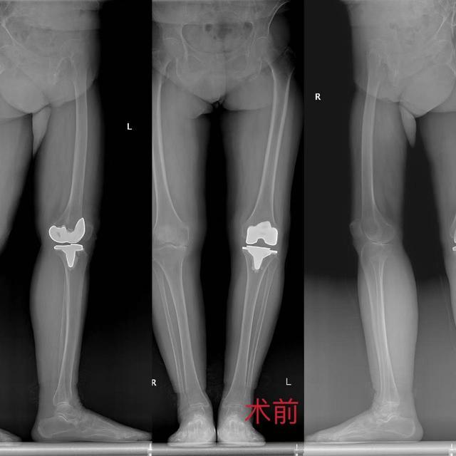 重医二院·医界绝技｜强“关”劲“节” ④ 80岁患者先后接受左右膝手术，单髁置换为她保留“膝”望