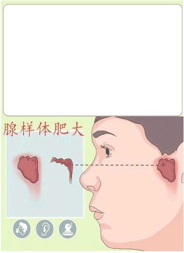 腺样体肥大成儿童“颜值杀手”