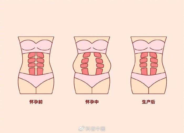 生孩子后腹直肌分离，最有用的修复方法是它！