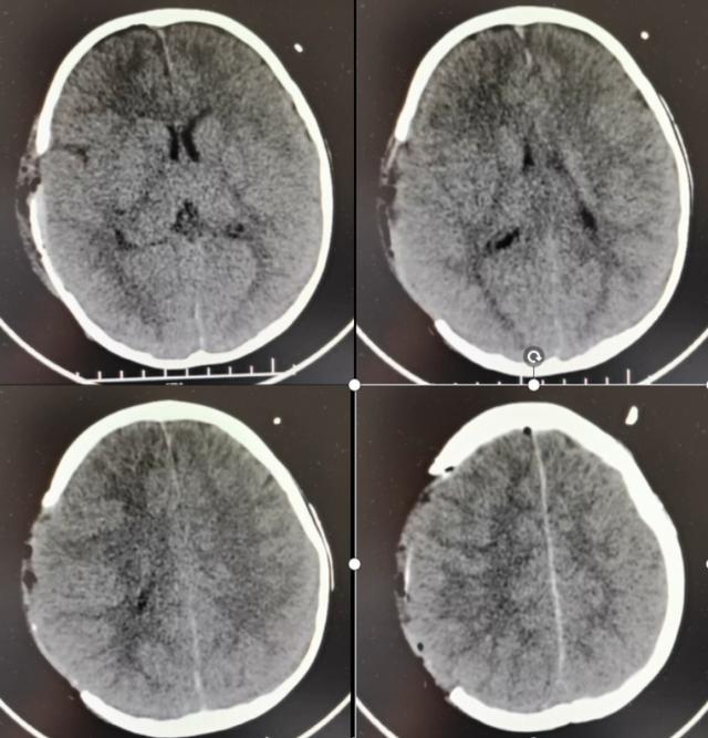 生死时速！重庆医科大学附属巴南医院成功抢救2岁颅脑重伤儿童