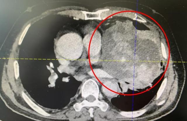 79岁大爷持续胸闷、呼吸困难，竟切出133毫米巨大肿瘤