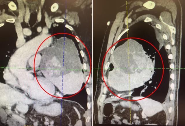 79岁大爷持续胸闷、呼吸困难，竟切出133毫米巨大肿瘤