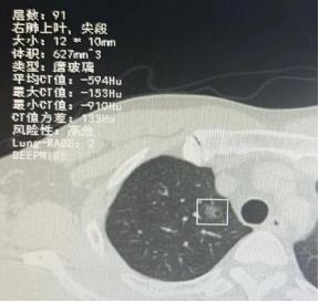 移动CT中国行 | 一站式超微创、高精准的肺结节治疗新方法