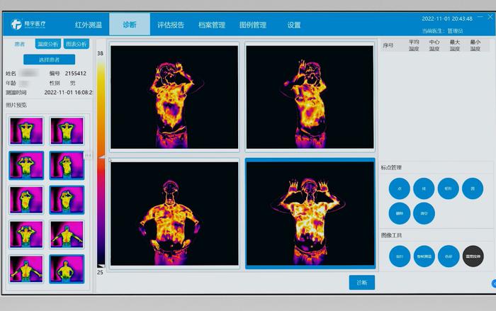 【康复之声】红外热成像技术在皮肤科疾病中的康复应用
