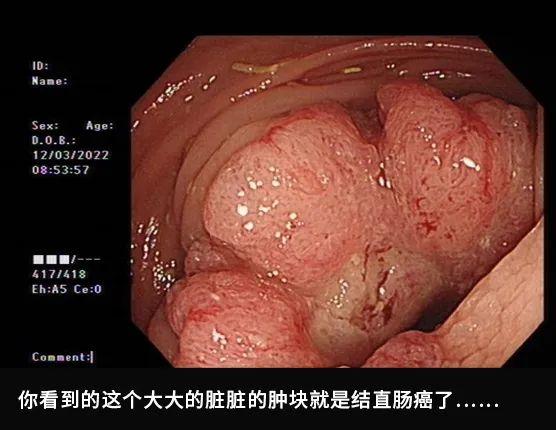 肠镜实拍：亲眼看看肠癌是怎么长出来的