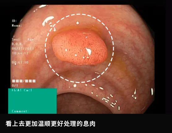 肠镜实拍：亲眼看看肠癌是怎么长出来的