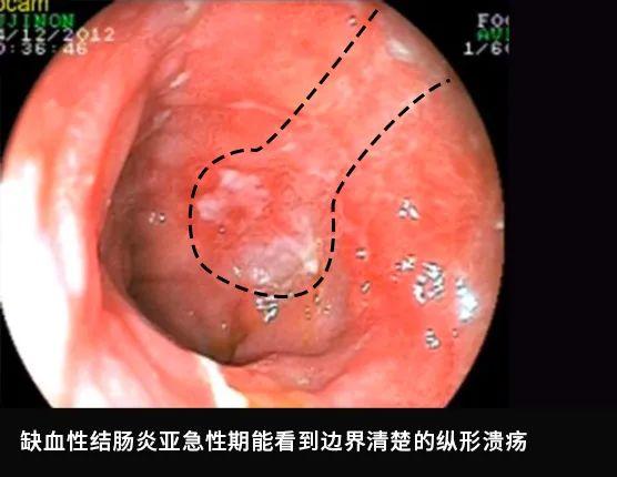 肠镜实拍：亲眼看看肠癌是怎么长出来的