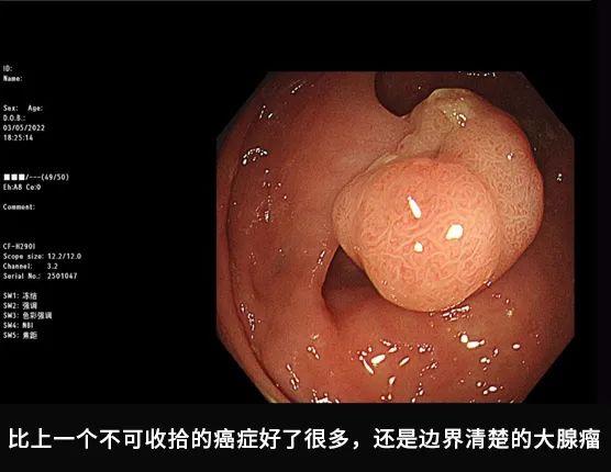 肠镜实拍：亲眼看看肠癌是怎么长出来的