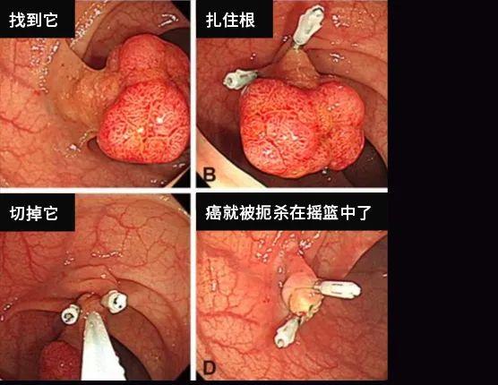 肠镜实拍：亲眼看看肠癌是怎么长出来的