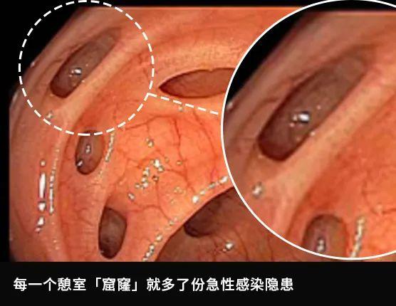 肠镜实拍：亲眼看看肠癌是怎么长出来的