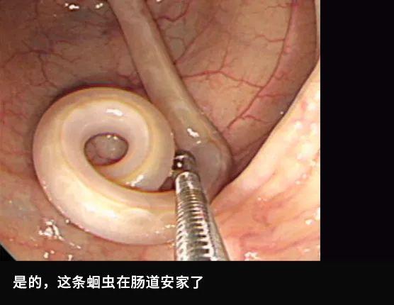 肠镜实拍：亲眼看看肠癌是怎么长出来的