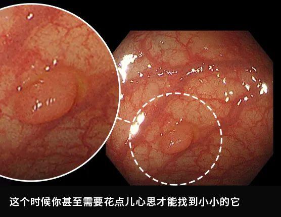 肠镜实拍：亲眼看看肠癌是怎么长出来的