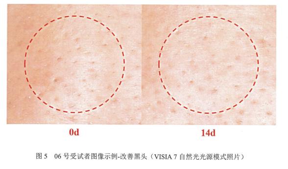 害怕黑头撑大毛孔，又不想伤皮肤，超简单的办法是……