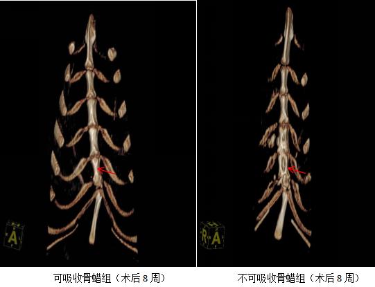 骨科止血材料再添新成员，直击临床骨创面止血痛点