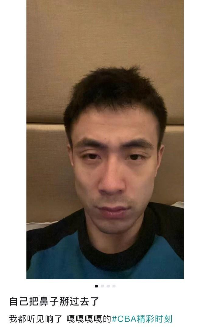 听着都疼赵继伟晒自拍：自己把鼻子掰过去了 听见嘎嘎响