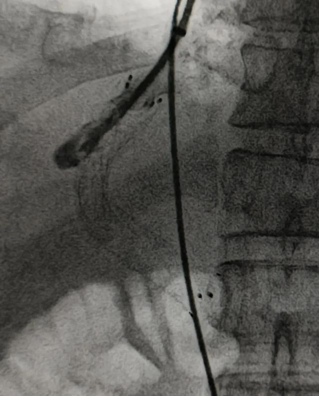 奋战6小时，再通生命之桥 一例肝硬化门脉高压TIPS支架闭塞再通