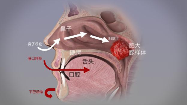 经常张口呼吸会变丑？网传的闭嘴贴到底有没有用