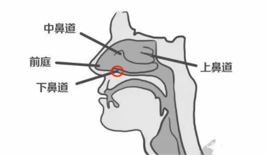 5岁娃脸肿流鼻血，而后高烧！就诊后鼻腔内取出纽扣电池，医生建议