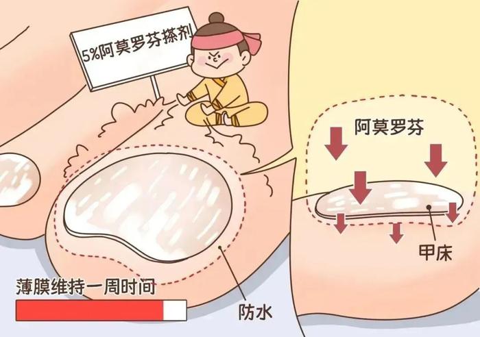 一个传染俩？一招解决「灰指甲」，省钱又管用