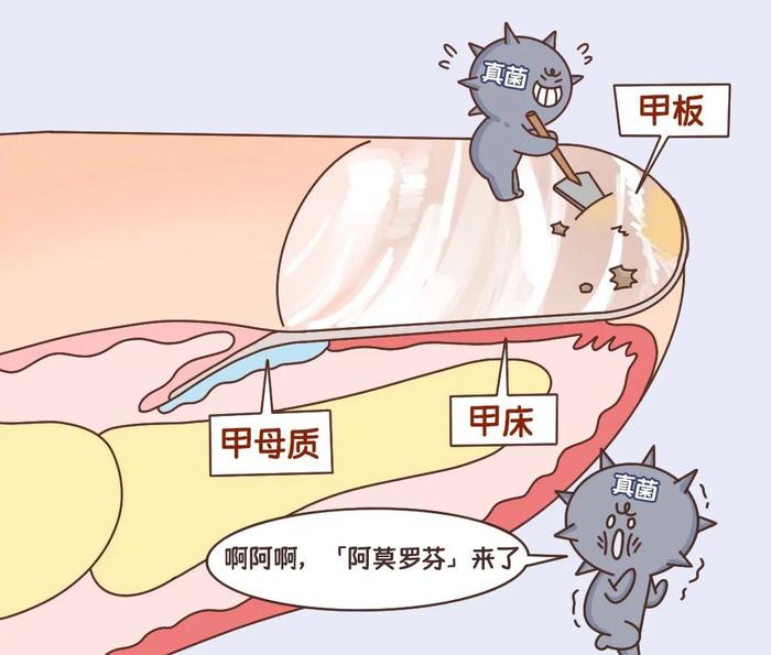 一个传染俩？一招解决「灰指甲」，省钱又管用