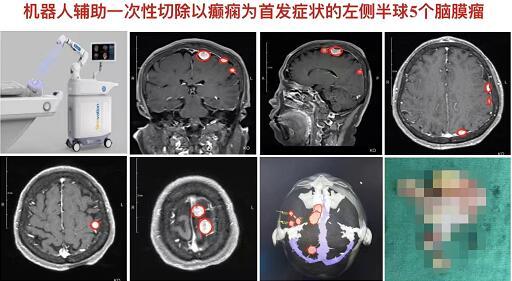 65岁大妈在公园锻炼突然摔倒，上海四院机器人精确定位辅助切除颅内多发脑膜瘤