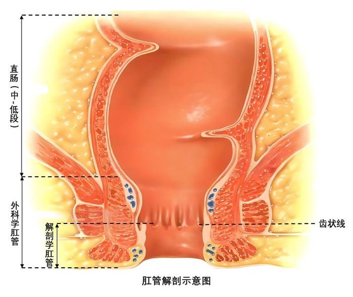 科普｜肛管鳞癌还是腺癌？治疗方法大不同！