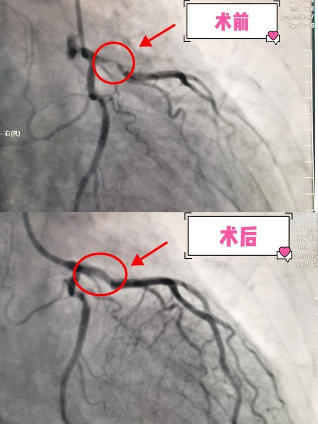 96岁超高龄心绞痛患者如何重获“心”生→