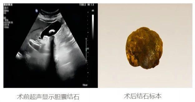 吉林省首例！吉大二院胃肠内科及消化内镜中心应用NOTES技术成功完成经胃内镜下保胆取石术