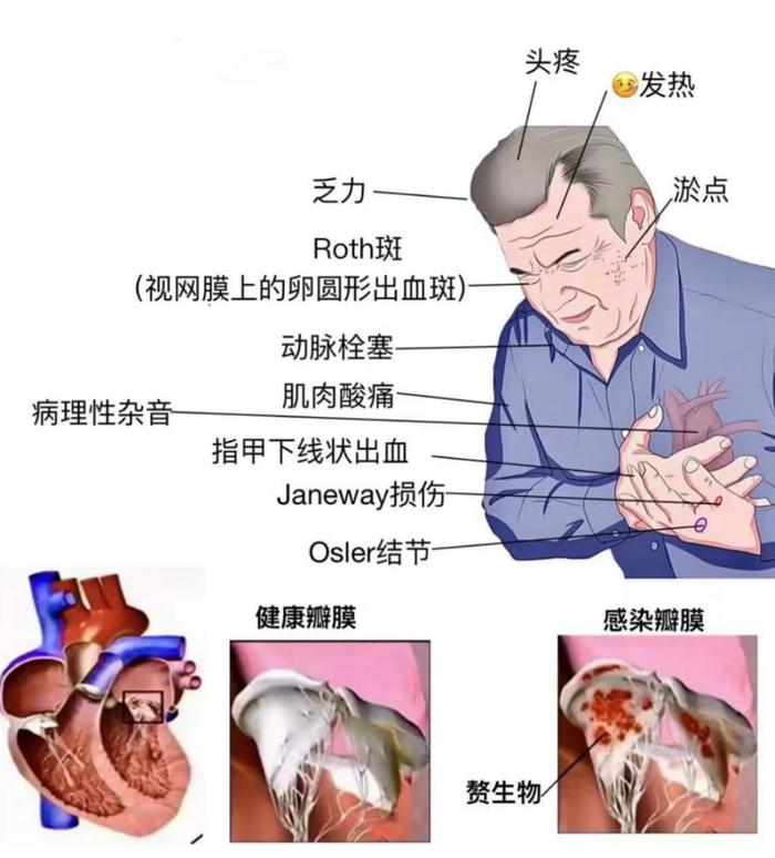 31岁小伙“四脏”衰竭，“普通感冒”差点要了命！医生提醒：有这种症状请尽快就医