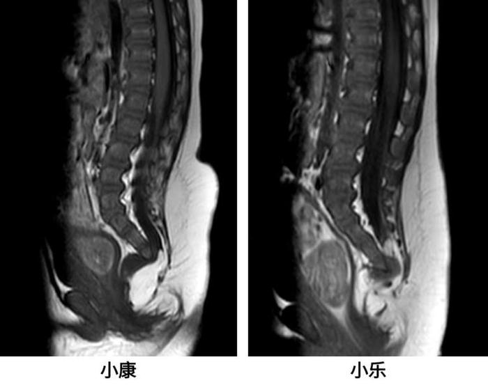 8个月双胞胎宝宝双双排便困难！竟确诊同一罕见病