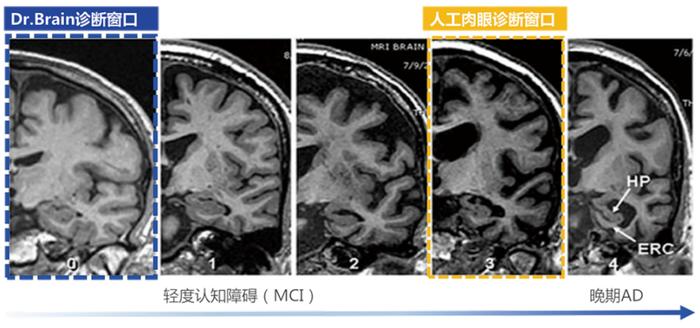 【参股公司医未医疗】获批AI卒中NMPA三类证丨中国唯一在AD及卒中领域均获三类证的企业