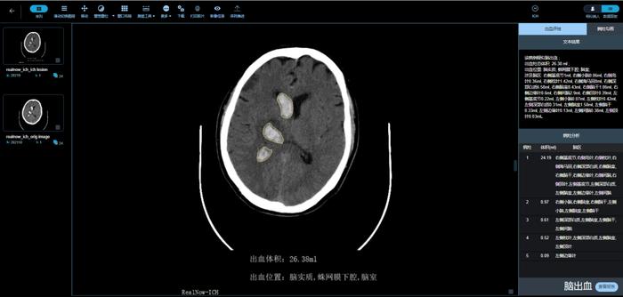 【参股公司医未医疗】获批AI卒中NMPA三类证丨中国唯一在AD及卒中领域均获三类证的企业