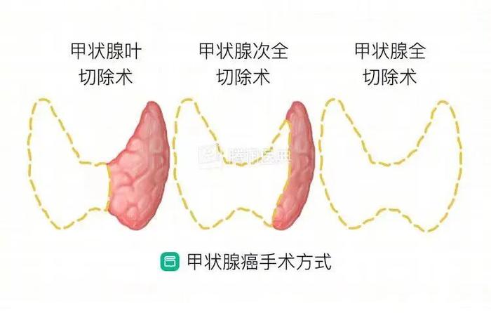 4万多人新发癌症，女比男多！深圳人肿瘤排行，“榜一”是它