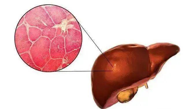 少吃多动就能治好脂肪肝吗？