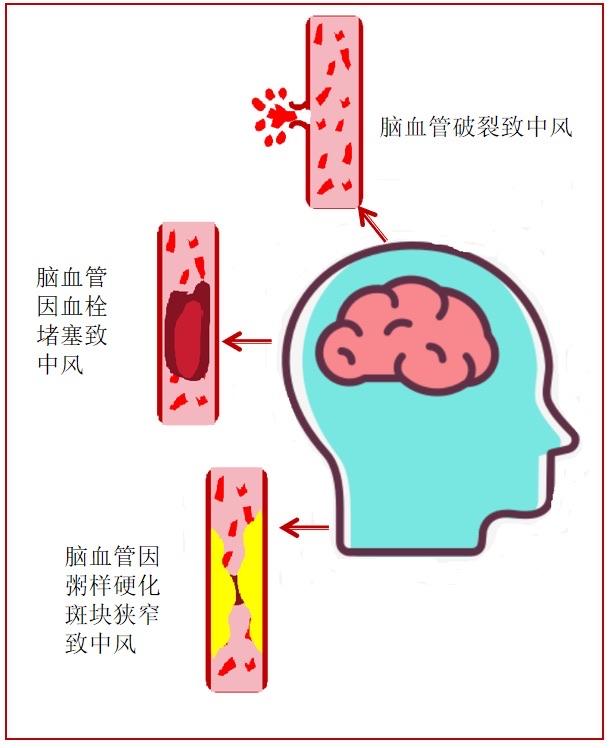 科普｜超声检查能提前预测中风吗？