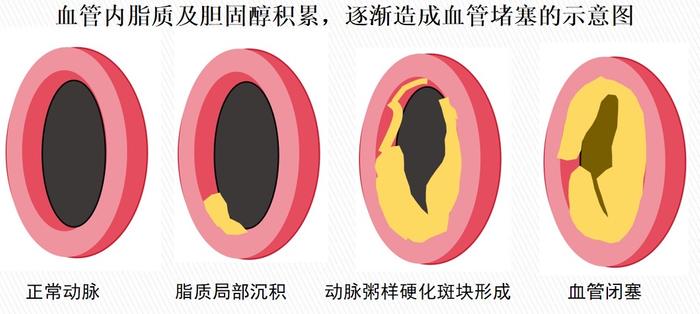 科普｜超声检查能提前预测中风吗？